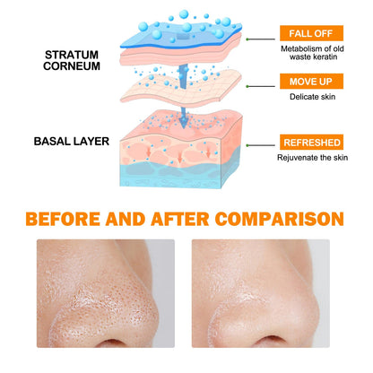 Exfoliating Blackhead Gel Gentle And Tender Skin